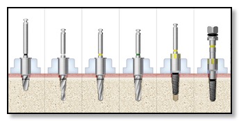 Hiossen Surgical Guide Drill Sequence